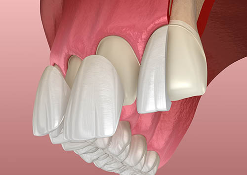 Dental Veneers