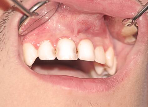 before dental restoration 1