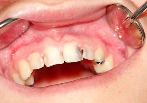 before dental restoration 2